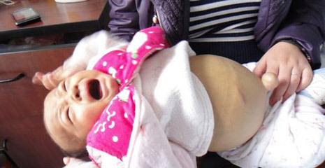 we救助-救助先天性 胆道闭锁 患儿应茄豪